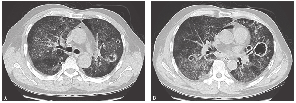 图9 病毒性肺炎胸部CT表现.jpg